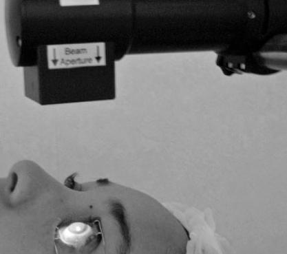 Procedimento de crosslinking de córnea: fonte de luz UVA sendo aplicada sobre a córnea com riboflavina para tratar ceratocone